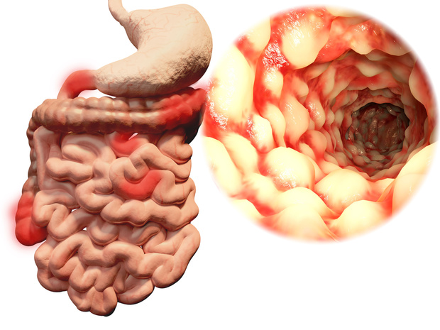 De ziekte van Crohn: risicomodel voor eerstegraadsverwanten