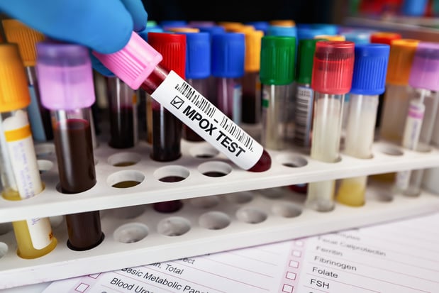 België rapporteert eerste besmetting met nieuwe mpox-variant