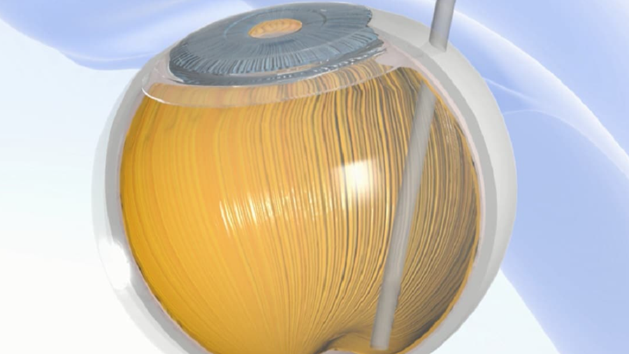 Résoudre le problème de la dégénérescence maculaire par un implant électronique