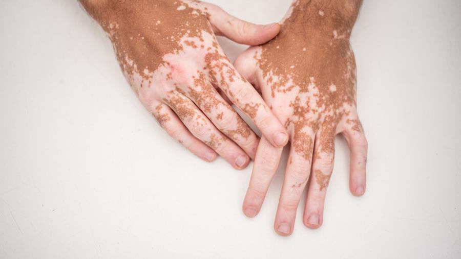 "Het is duidelijk dat de aanpak van vitiligo kan worden verbeterd"